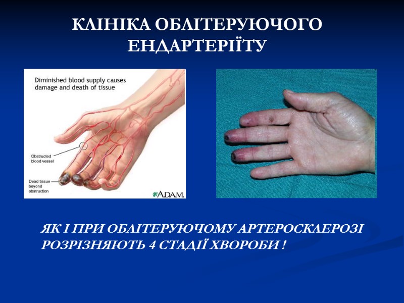 КЛІНІКА ОБЛІТЕРУЮЧОГО ЕНДАРТЕРІЇТУ ЯК І ПРИ ОБЛІТЕРУЮЧОМУ АРТЕРОСКЛЕРОЗІ РОЗРІЗНЯЮТЬ 4 СТАДІЇ ХВОРОБИ КЛІНІКА ОБЛІТЕРУЮЧОГО ЕНДАРТЕРІЇТУ ЯК І ПРИ ОБЛІТЕРУЮЧОМУ АРТЕРОСКЛЕРОЗІ РОЗРІЗНЯЮТЬ 4 СТАДІЇ ХВОРОБИ